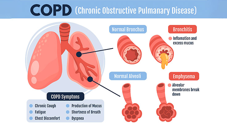 क्रोनिक ओब्सट्रक्टिव पल्मोनरी डिजीज (COPD) का प्रबंधन